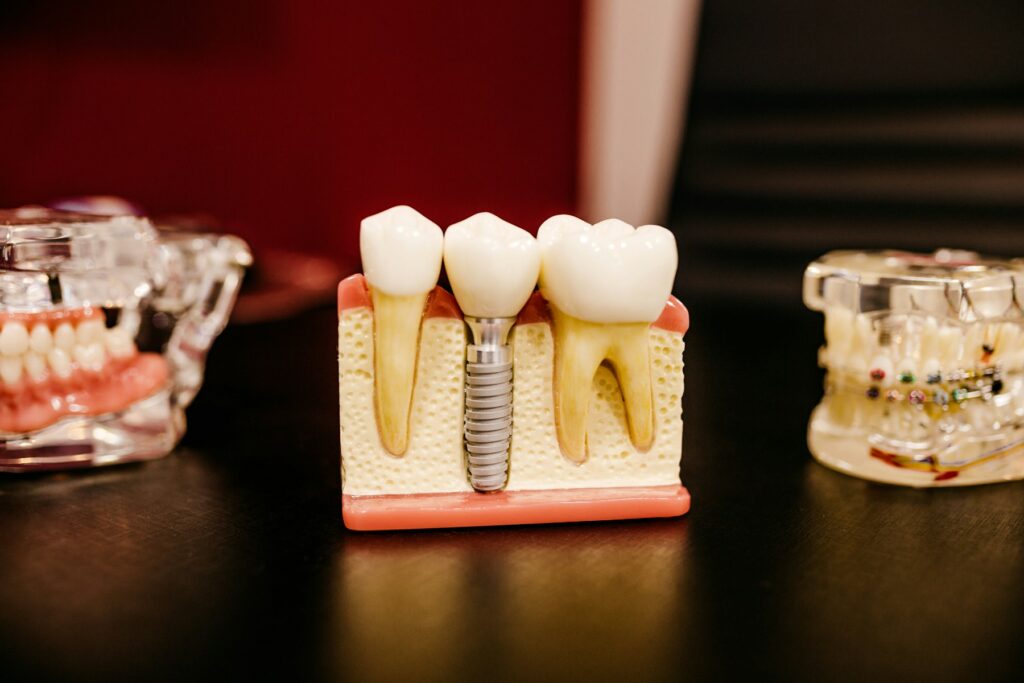 A model showing a dental implant between natural teeth
